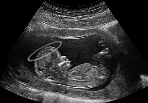 Ultraschallbild von Baby mit Heiligenschein